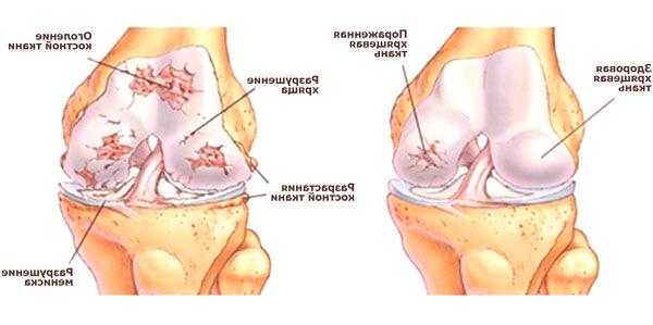 deformirajuća artroza liječenje mastima zgloba koljena